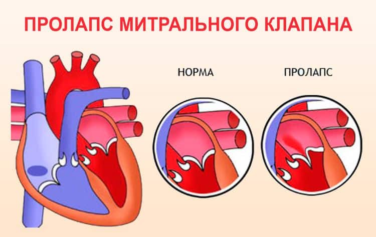 Пролапс митрального клапана