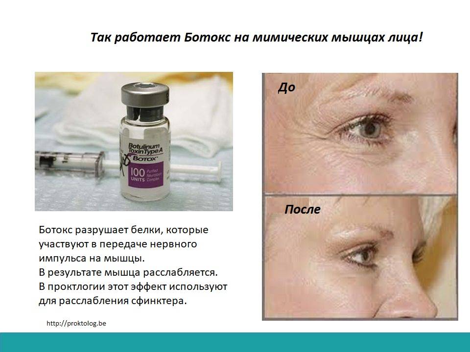 Ботокс