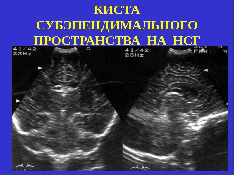 Субэпендимальная киста: причины, чем и когда опасна, диагностика, лечение, прогноз