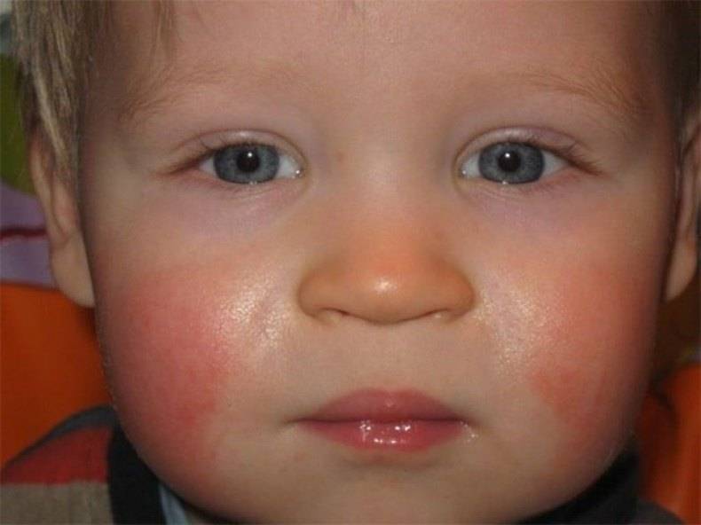Побочные реакции у детей у детей. Покраснение на щеке у ребенка. Покраснения на лице у грудничка.