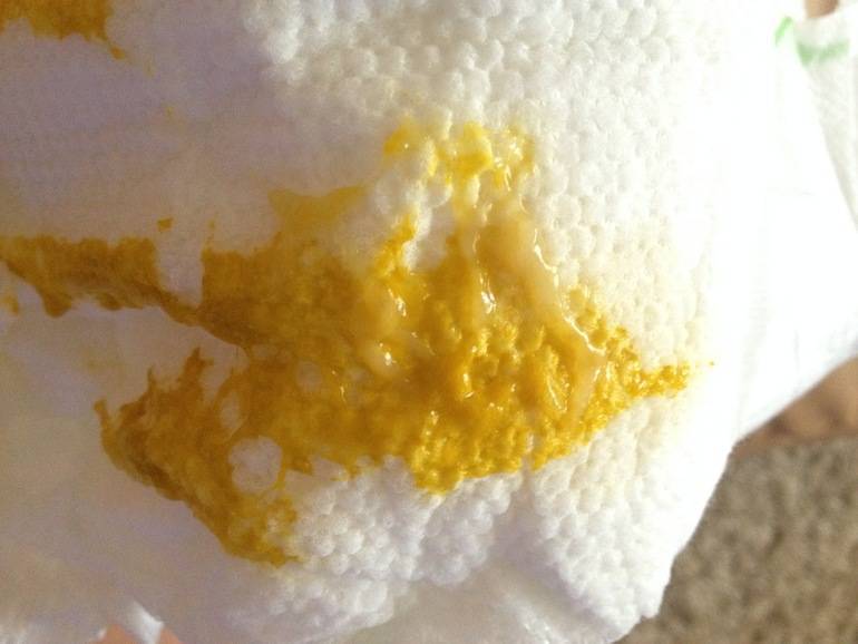 Зеленый стул со слизью у грудничка: причины и профилактика | ru-babyhealth