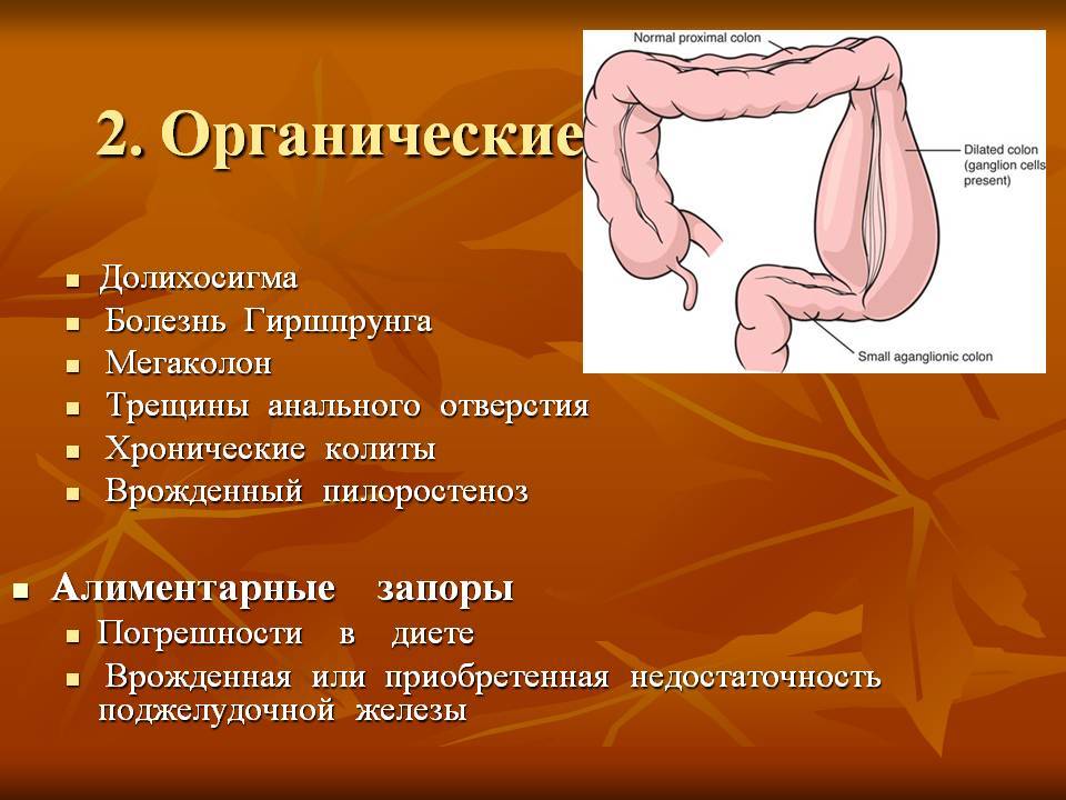 Долихосигма кишечника у взрослых: симптомы лечение | все о жкт.ру