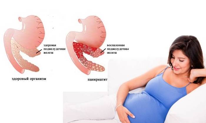 Панкреатит при беременности: опасности, диагностика и безопасная терапия