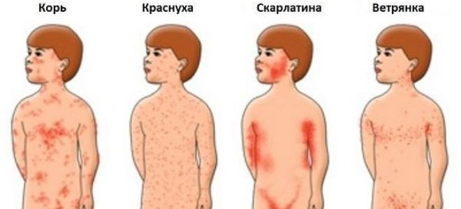 Крапивница у детей: 3 основные причины, симптомы, лечение, профилактика, видео