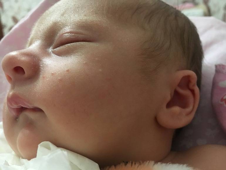 Прыщики на лице новорожденного в 1 2 месяц: белые, красные, мелкие на попе