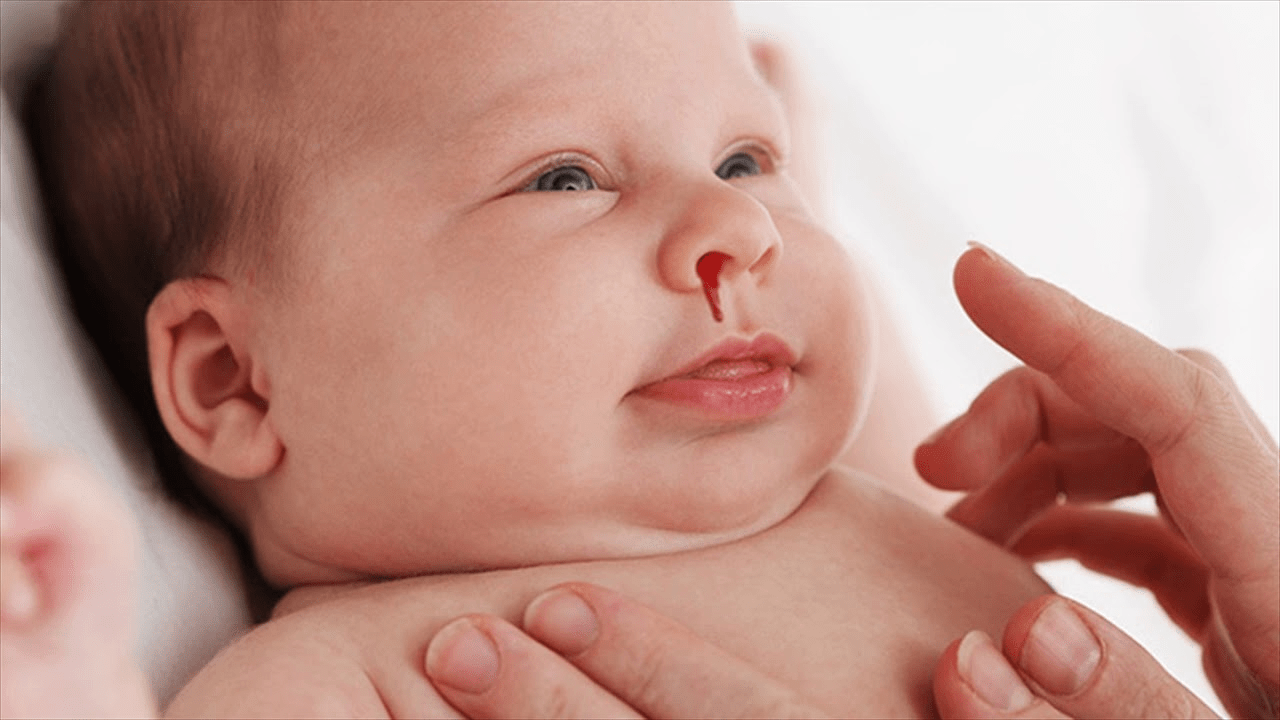 Почему новорожденный хрипит. Кровоточивость у новорожденных. Повышенная кровоточивость у детей. Гемофилия у новорожденных.