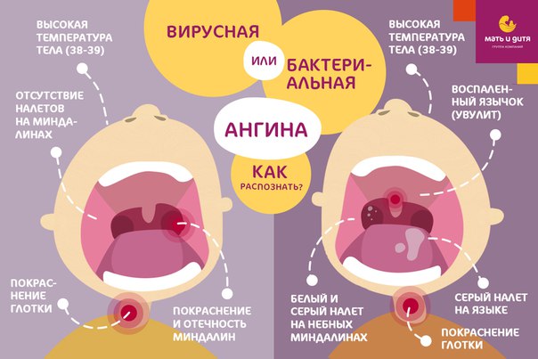 Как выглядит здоровое и больное горло у ребенка на фото, какие есть правила осмотра?