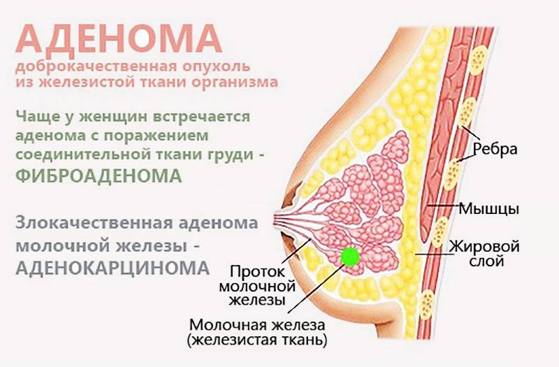Основные симптомы и способы лечения лактостаза у кормящей матери