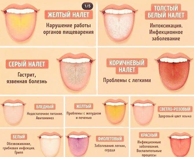 Белый налет на языке у грудничка и ребенка старшего возраста: почему появляется, что делать?