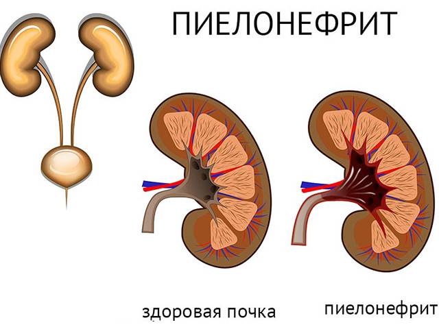 Пиелонефрит у грудничка: причины, симптомы и лечение | prof-medstail.ru