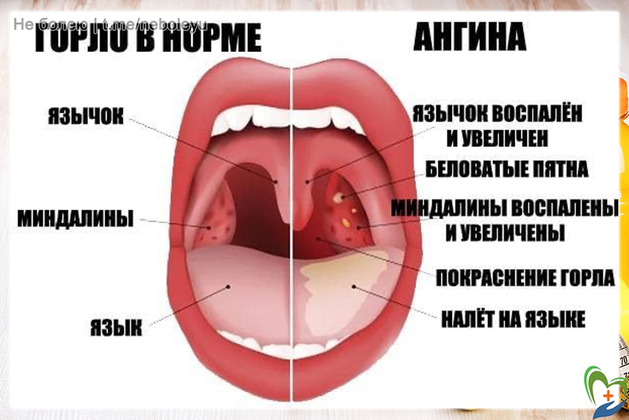 Ангина при грудном вскармливании – как лечить и можно ли кормить ребенка