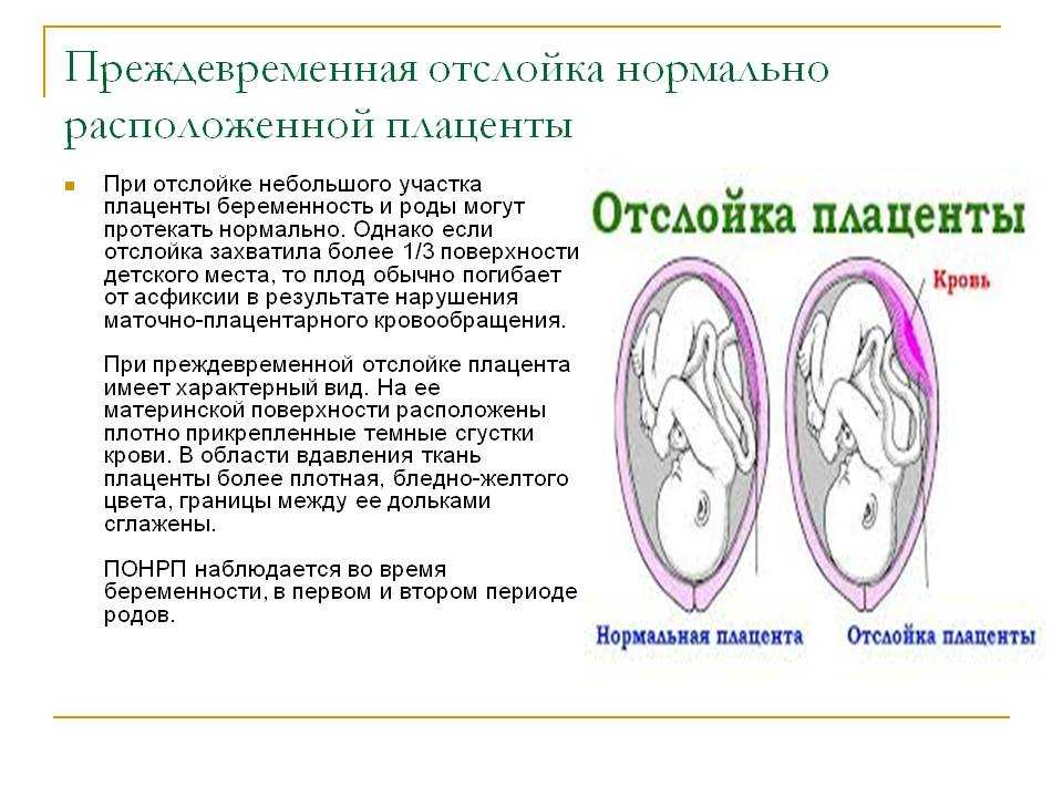 Причины и симптомы отслойки плаценты на разных сроках, лечение и последствия