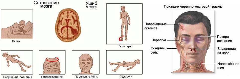 Ребёнок ударился бровью: синяк, гематома, что делать?