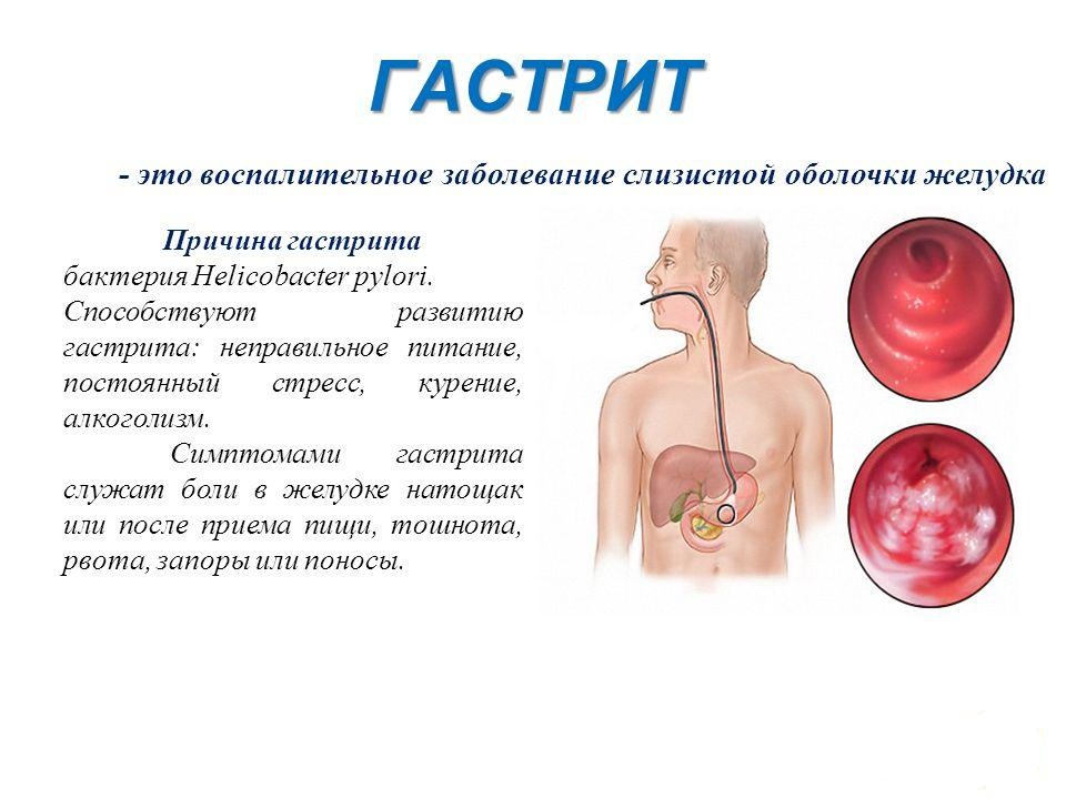 Лекарства при грудном вскармливании при гастрите: безопасные и эффективные препараты