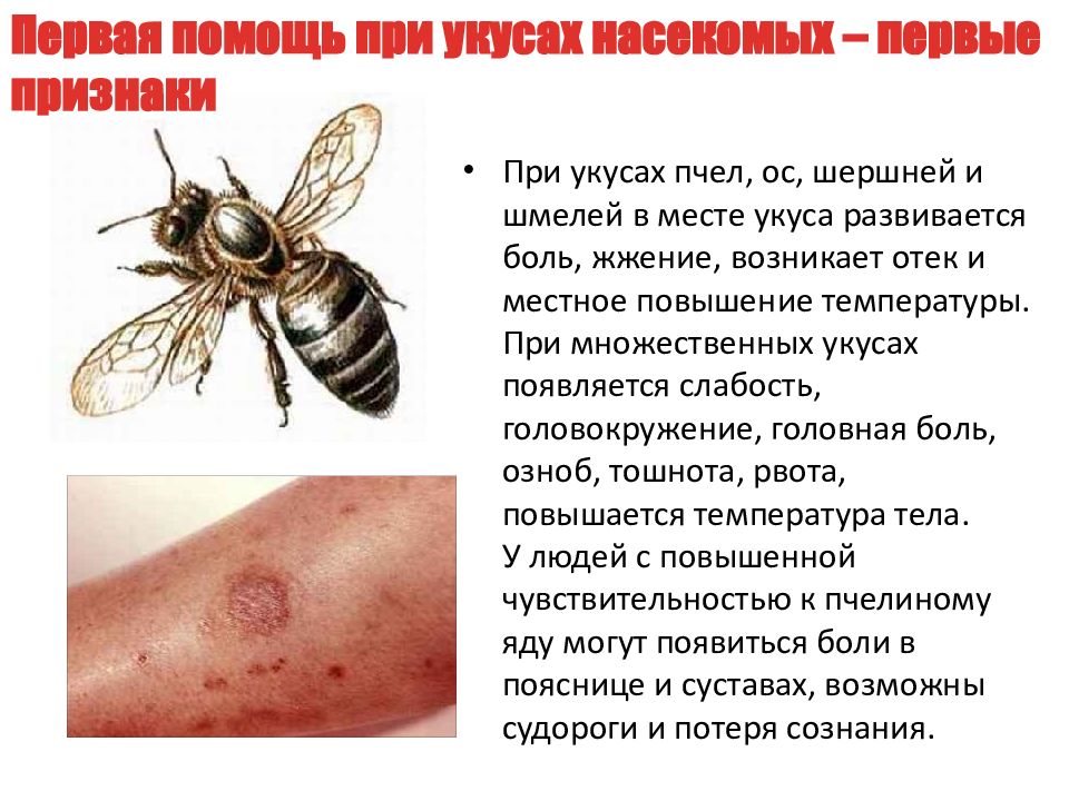 Ребенка укусила пчела или оса