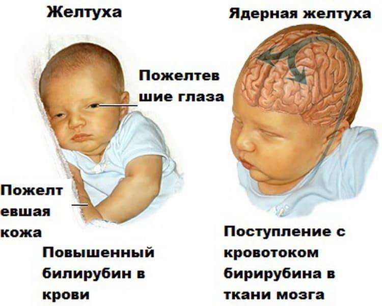 Желтуха новорожденных. диагностика, лечение, последствия и профилактика желтухи новорожденных