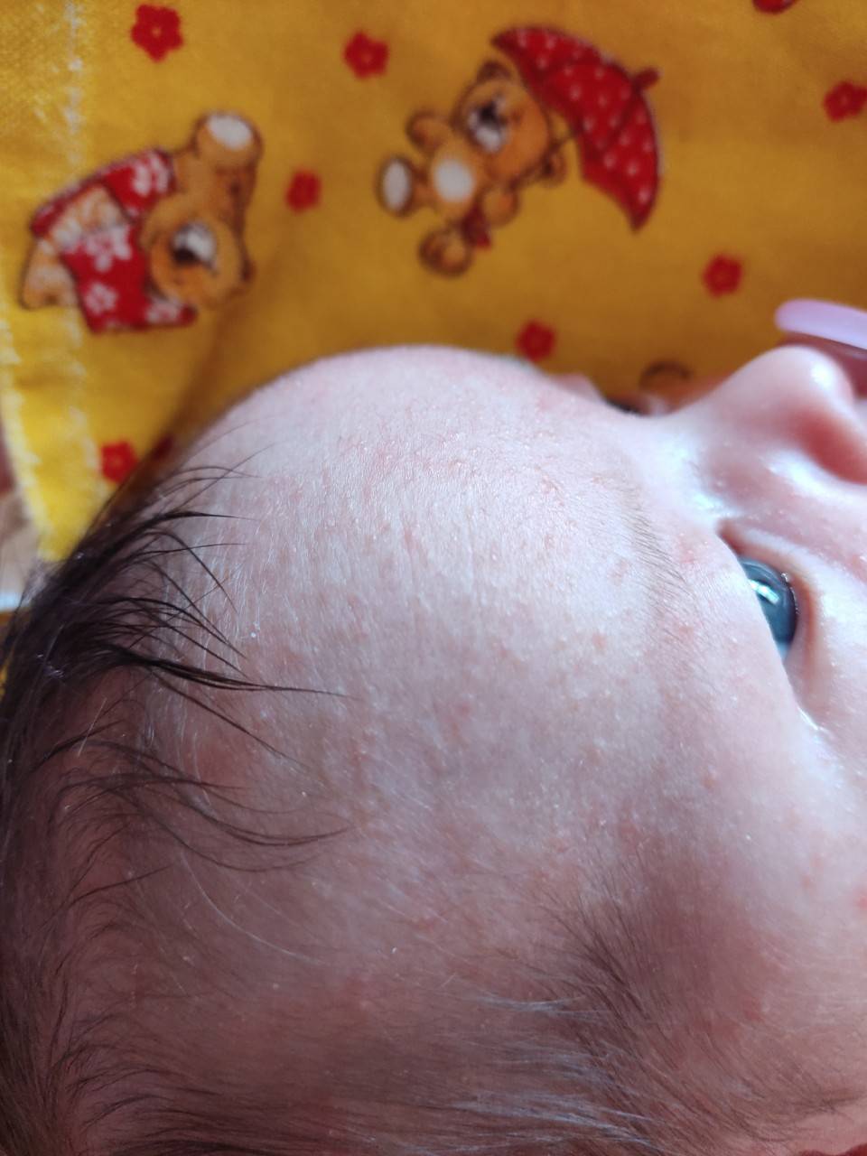 Сыпь у новорожденного: как определить причину