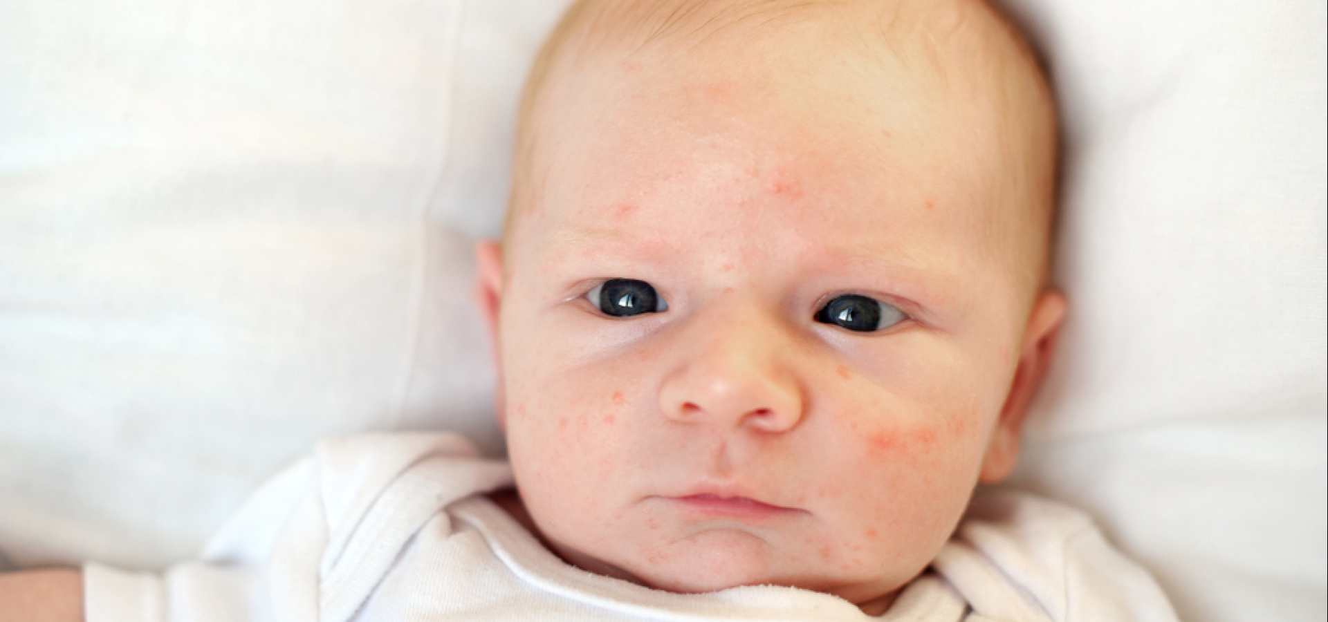 Прыщики на лице у новорожденного: разновидности, белые, красные,чем лечить, что можно делать а что нельзя