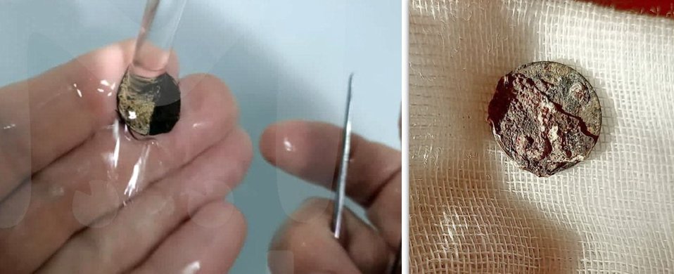 Как у ребенка из носа достать инородное тело