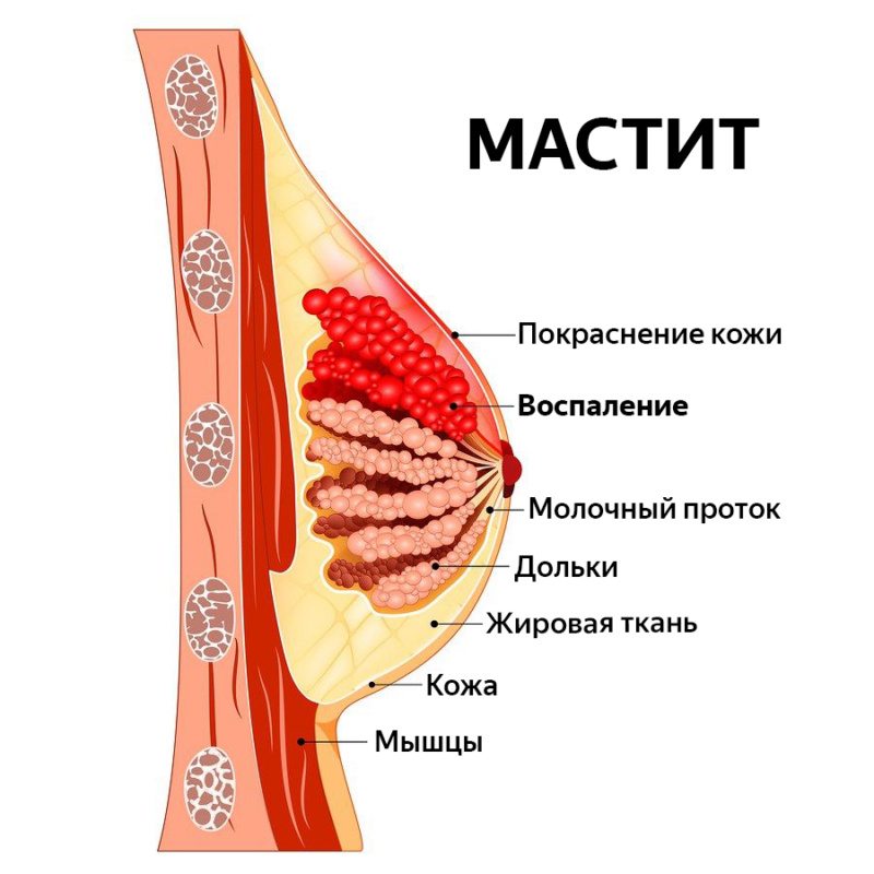 Уплотнение в молочной железе при грудном вскармливании у кормящей мамы