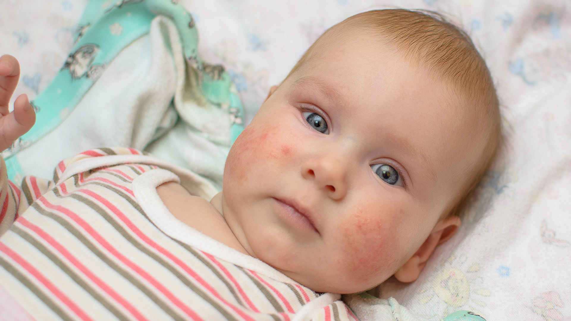 Атопич. Атопический дерматит Младен. Атопический дерматит у детей. Атопический дерматит у малыша.