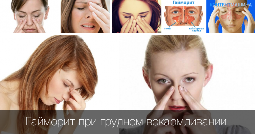 Гайморит: расположение пазух, причины, как проявляется, лекарства и средства, ингаляции, процедура «ямик», что делать, чтобы избавиться от болезни, меры профилактики