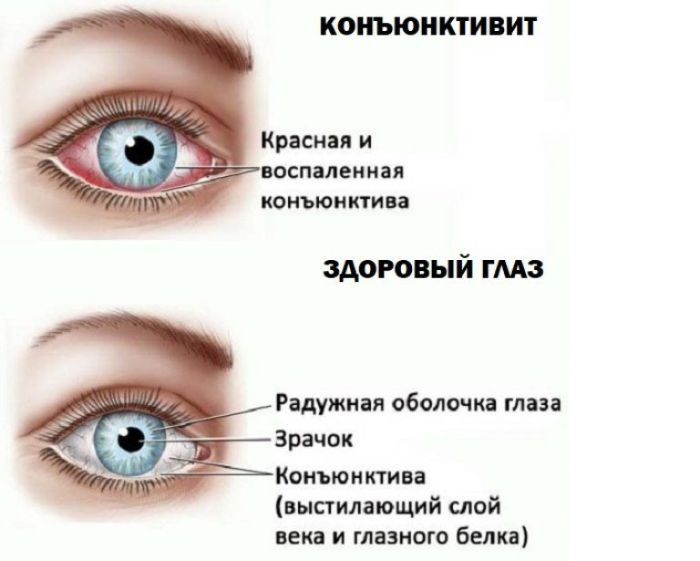 10 советов родителям при аллергическом конъюнктивите у ребёнка