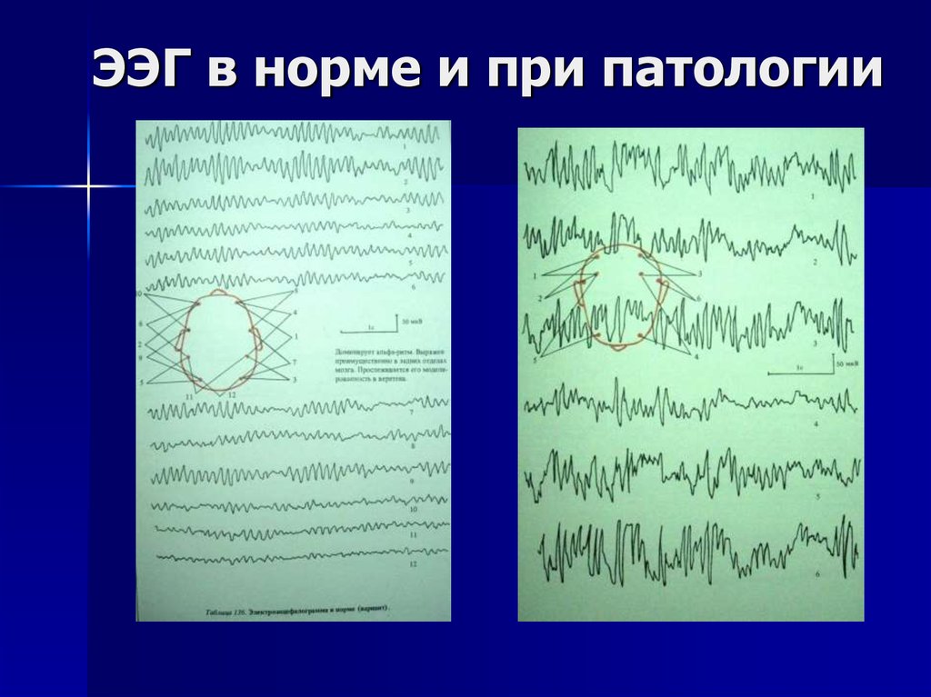 Электроэнцефалография (ээг) головного мозга: что это, показания и противопоказания, подготовка и ход исследования, расшифровка, плюсы и минусы