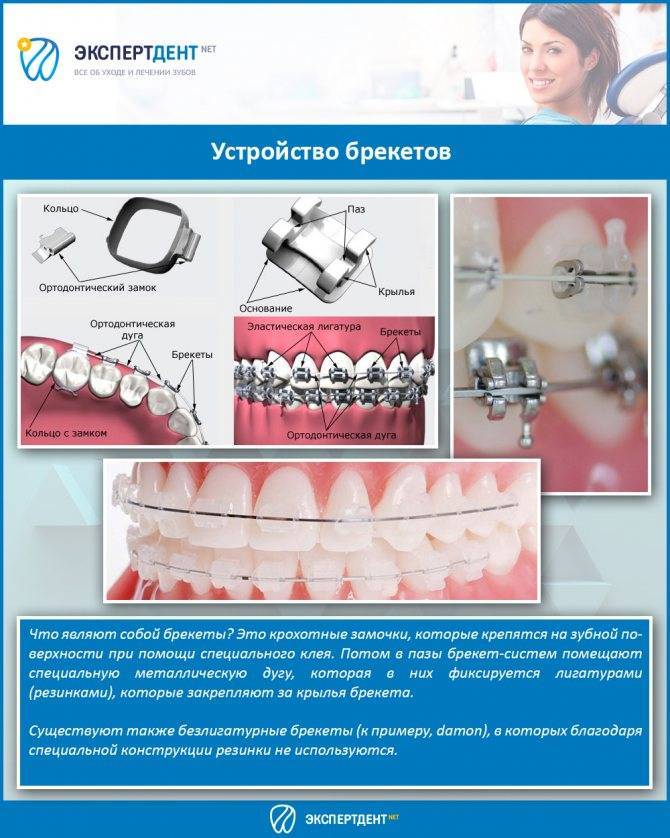 Брекеты проект 10 класс