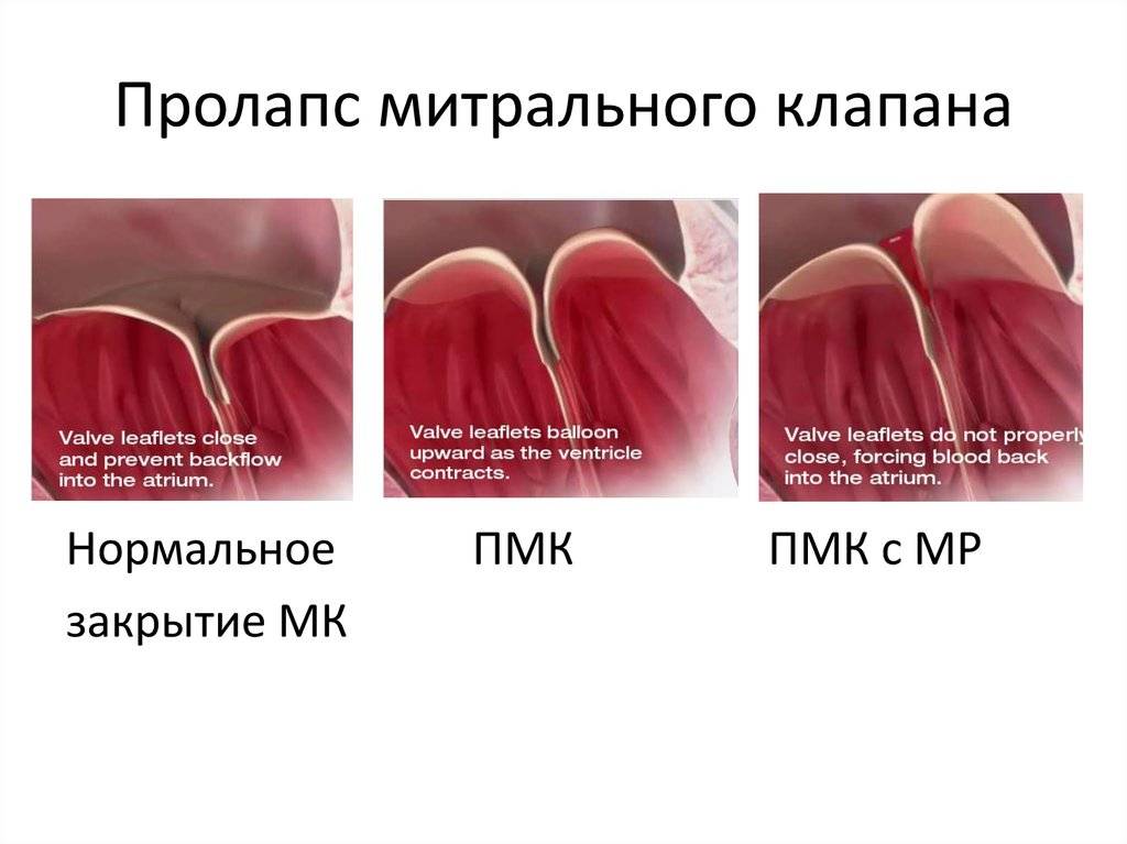 Пролабирование сердечных клапанов – норма или патология? разбираемся с детским кардиологом