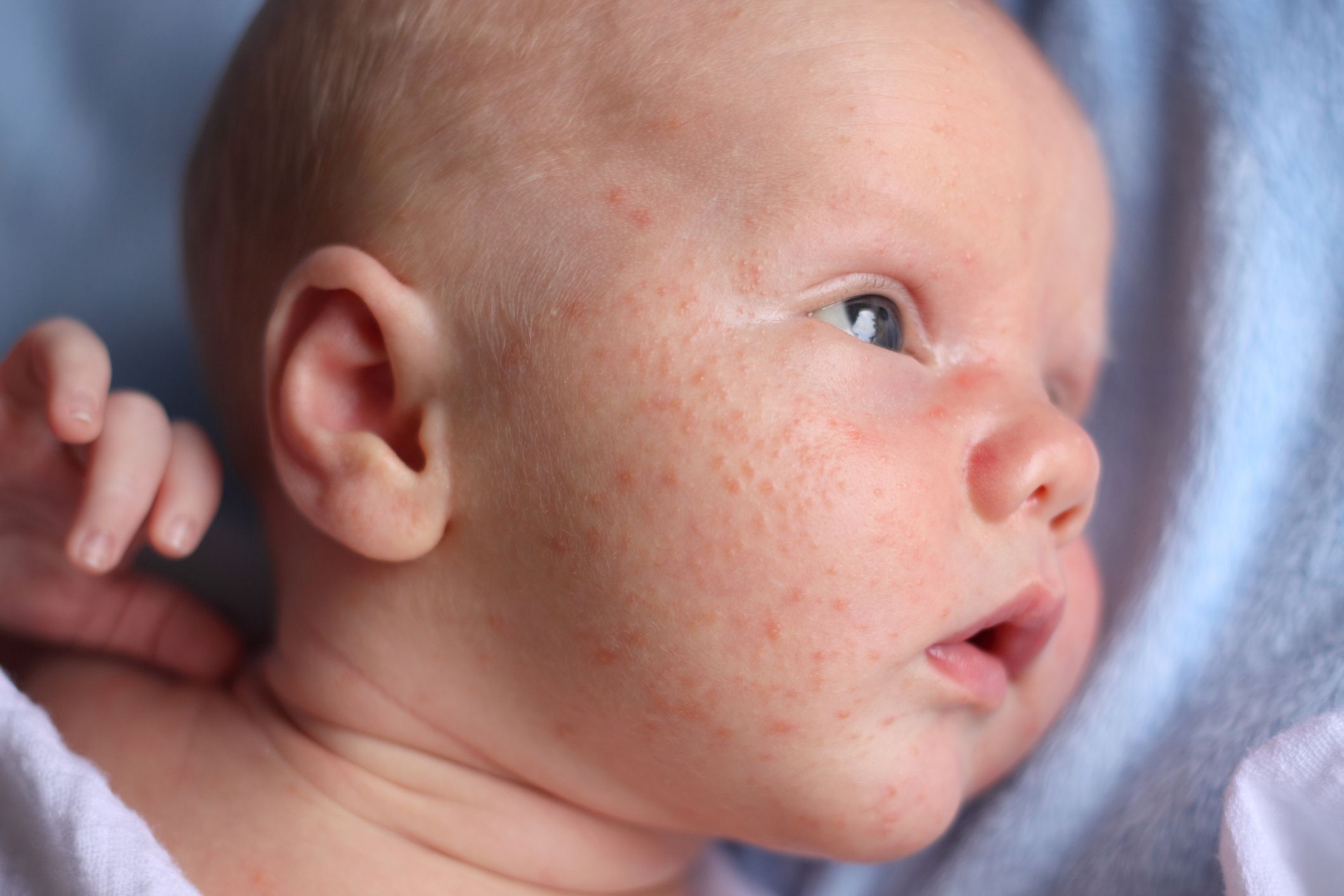 Прыщики на лице у новорожденного в 1 месяц: мелкие, красные на голове, щечках и лбу, а также белые и гнойнички
