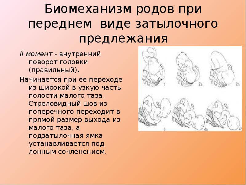 Тазовое предлежание плода: как исправить ситуацию