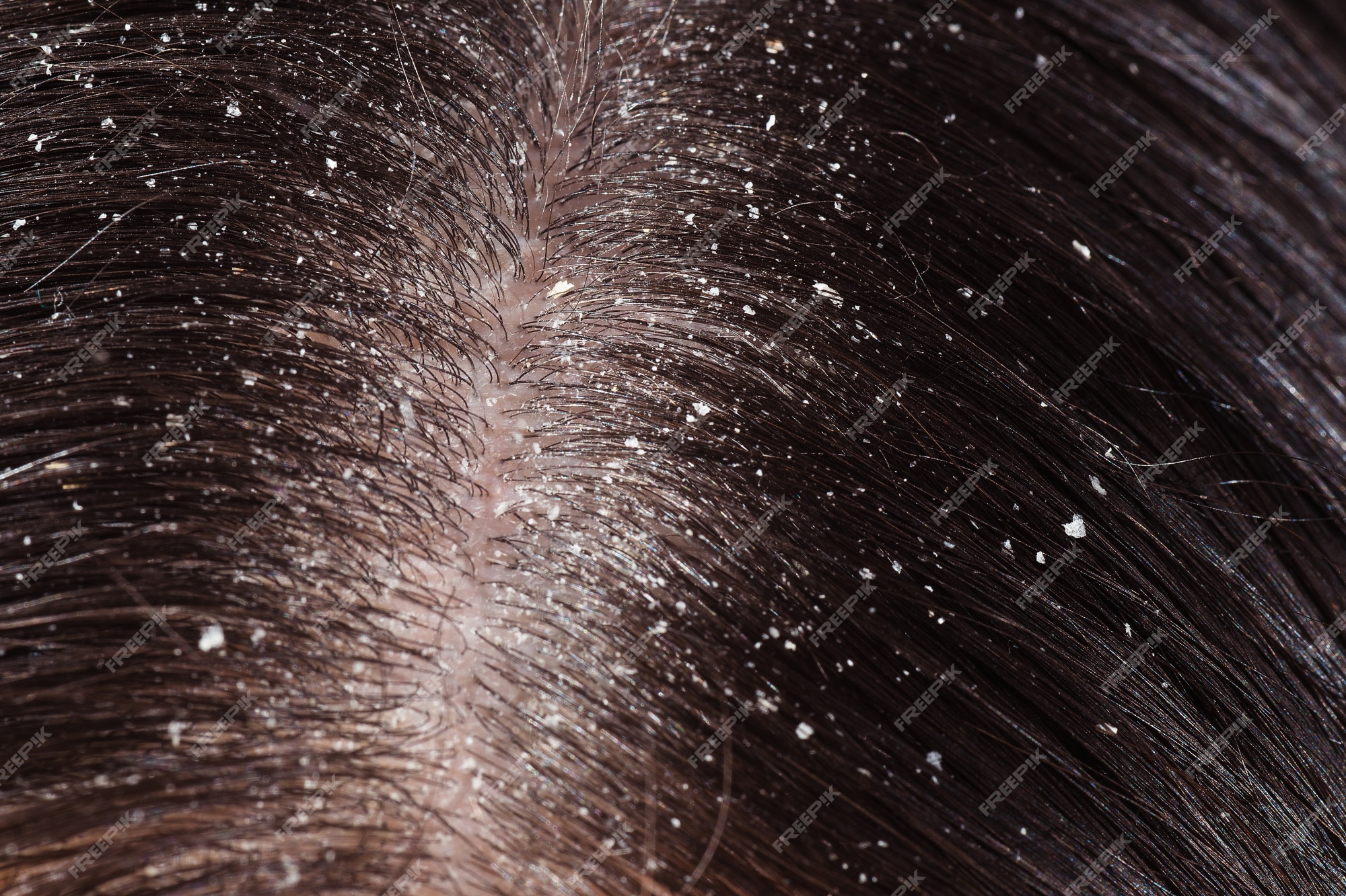 Причина появления волос. Себорея и себорейный дерматит. Себорея волосистой кожи головы. Себорея волосяного Покрова.