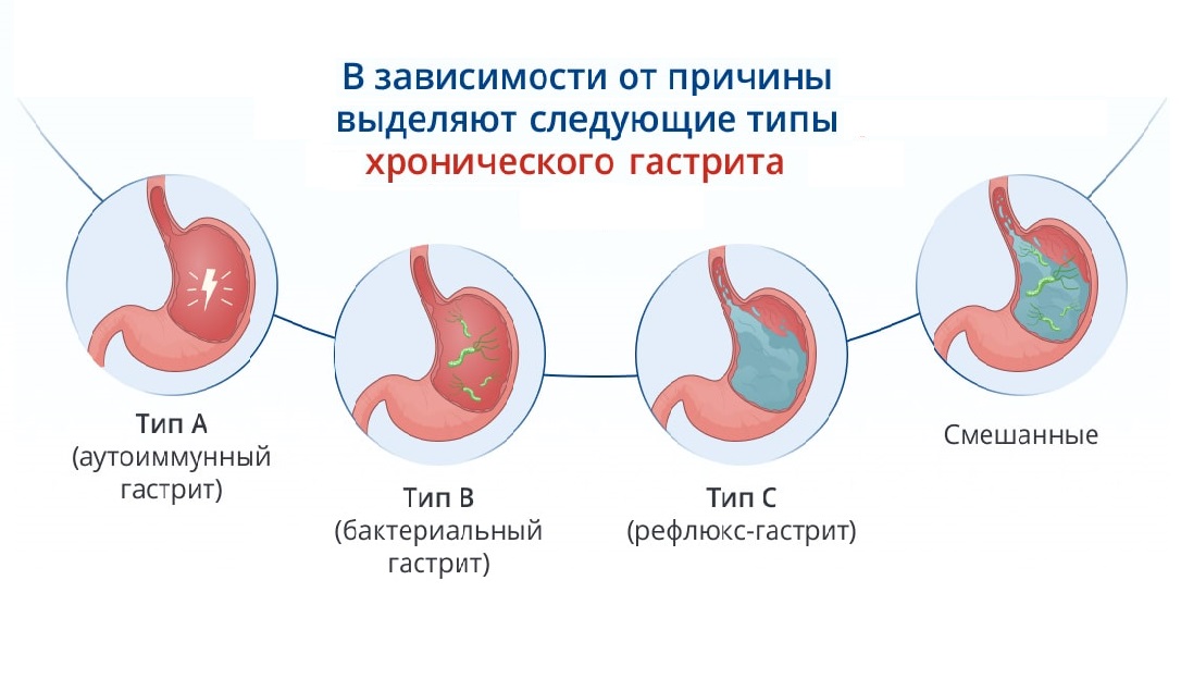 Причина гастрита б. Тип секреции при обострении хронического гастрита типа в. Хронический аутоиммунный гастрит клиника. Патогенез бактериального хронического гастрита. Хронический гастрит патогенез схема.