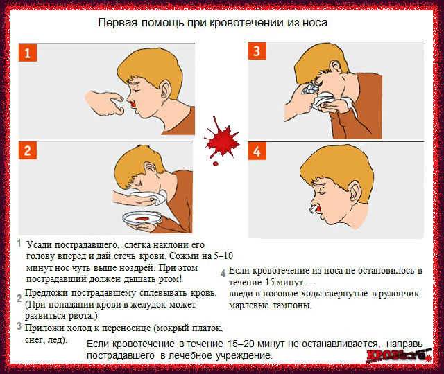 Носовое кровотечение у детей - симптомы болезни, профилактика и лечение носового кровотечения у детей, причины заболевания и его диагностика на eurolab