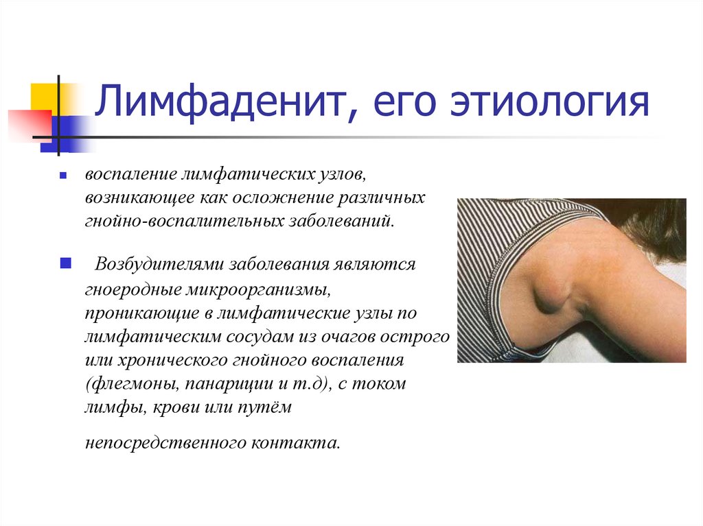 Лимфаденопатия шейных лимфоузлов у взрослых и детей