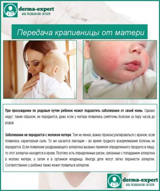 Аллергия на молоко у ребенка: симптомы и диагностика