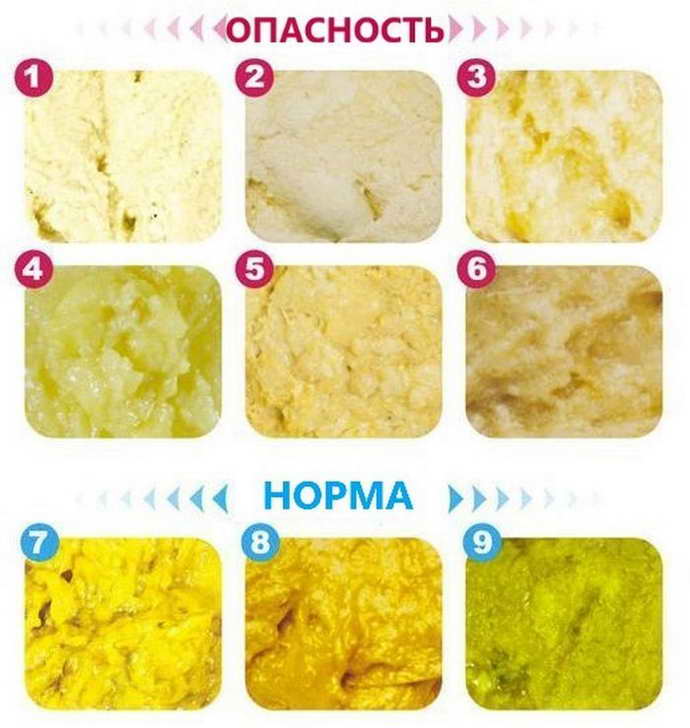 Желтый стул у новорожденного: стоит ли беспокоиться?