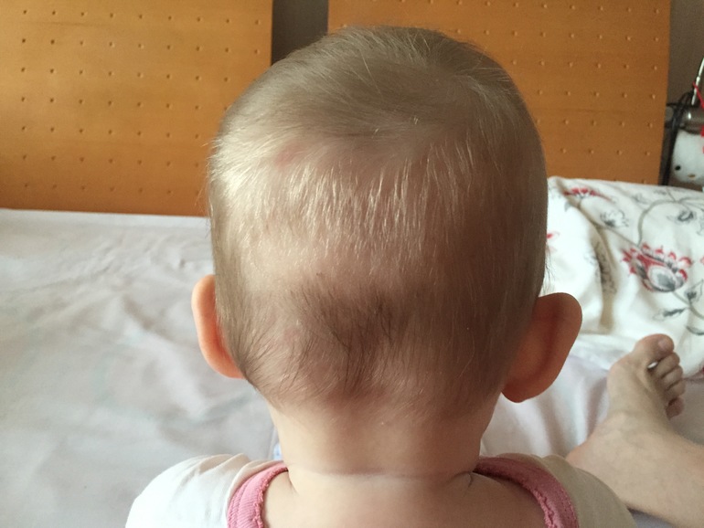 Почему появляется шишка на голове у ребенка без удара - mums.ru
