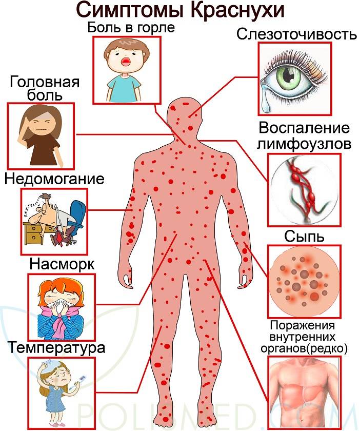 Корь: причины, симптомы, диагностика и лечение. вакцинация против кори.