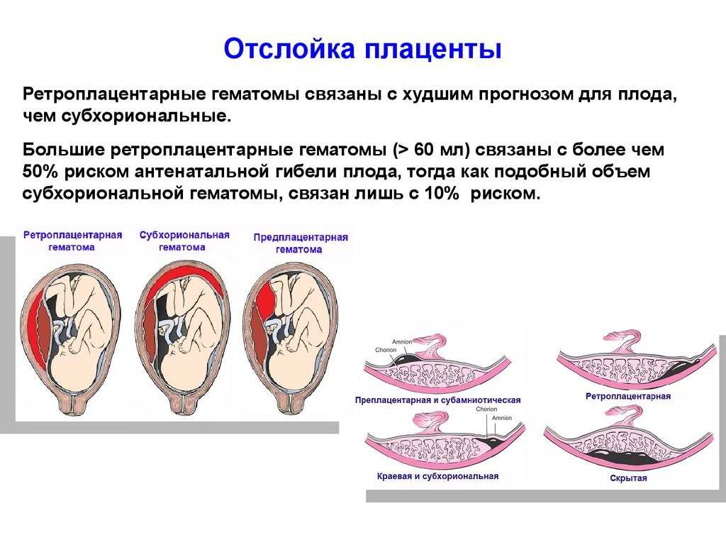 Отслойка плаценты на поздних сроках беременности | уроки для мам