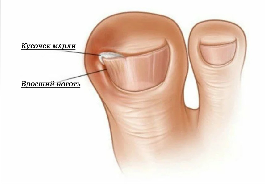 Что делать у новорожденного ноготь на ноге врастает в кожу