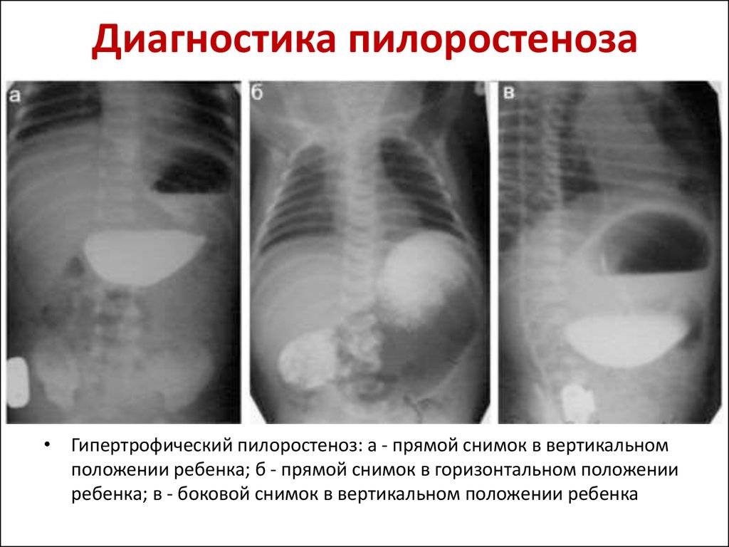 Пилоростеноз у детей