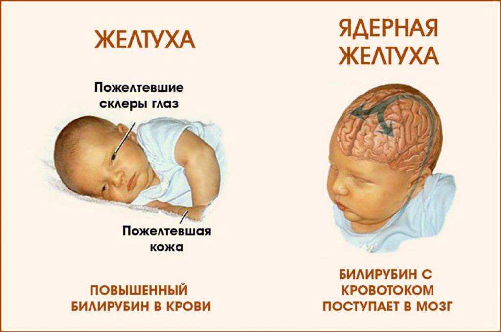 Желтуха у новорожденных: причины и последствия, признаки, когда должна пройти. сколько длится детская желтуха?