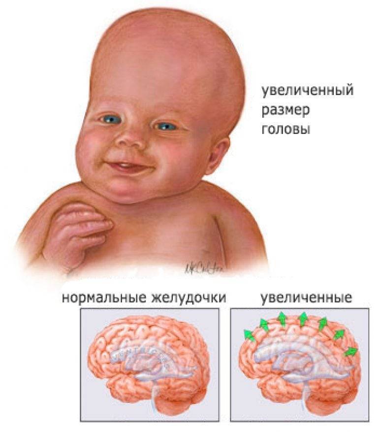 Симптомы гидроцефалии головного мозга у новорожденных и детей до года, последствия и лечение водянки