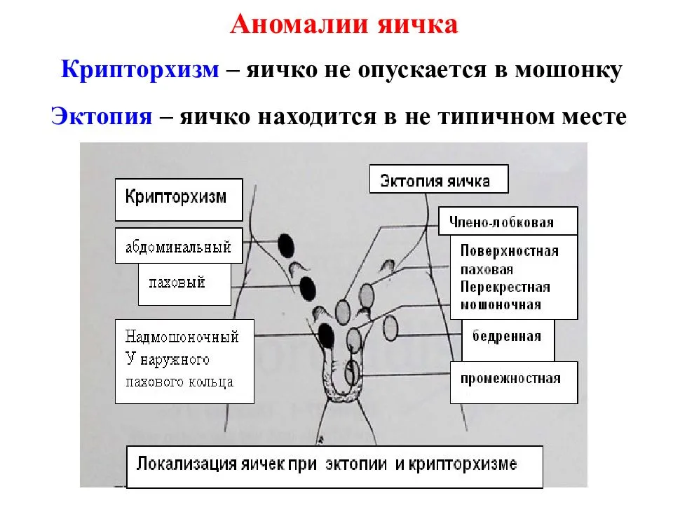 Что делать, если у новорождённого мальчика не опустились яички. причины и последствия