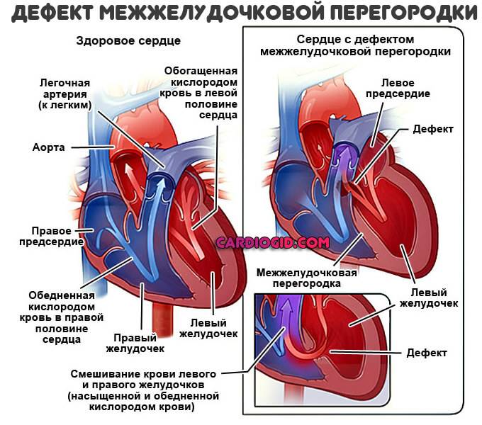 Дмжп у новорожденного: причины дефекта межжелудочковой перегородки, симптомы и лечение