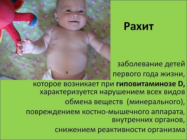 Рахит у грудничков: признаки, причины, симптомы и профилактика заболевания у новорождённых