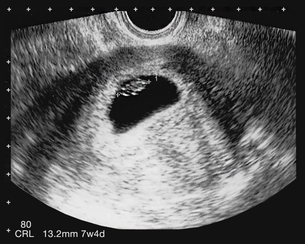 7 недель мальчику. 7 Неделя беременности акушерская УЗИ УЗИ. Эмбрион на 7 неделе беременности УЗИ. УЗИ 7 недель беременности УЗИ. УЗИ на 7 акушерской неделе беременности.