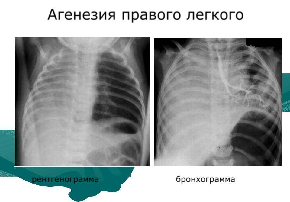 Клинический случай агенезии легкого у ребенка грудного возраста | интернет-издание "новости медицины и фармации"